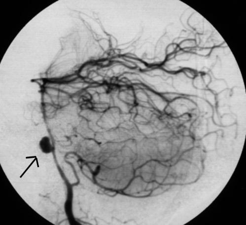 Aneurysma