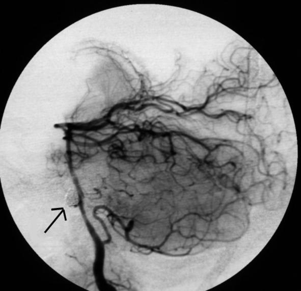 Aneurysma nach Coilen