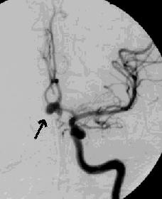 Darstellung Aneurysma Angiographie