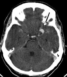 Darstellung Aneurysma CT