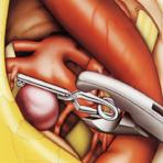 Geklipptes Aneurysma Geklipptes Aneurysma